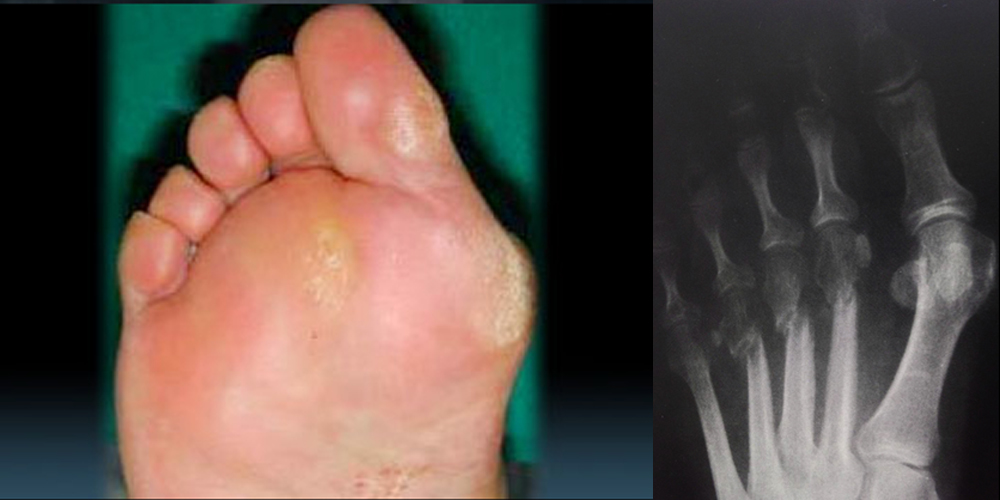 artralgia piede