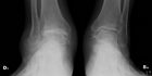 Artrosi di caviglia - Dott Roberto Pelucchi